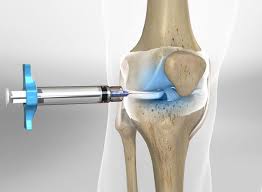 💉 DISTRIBUTORSHIP AND SUPPLY REQUEST FOR INJECTION PRODUCTS FOR JOINT OSTEOARTHRITIS – EXPORT OPPORTUNITY FROM TURKEY TO EGYPT