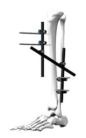 🦴 Tender for the Supply of Orthopedic Fracture Materials for the Iraqi Ministry of Health