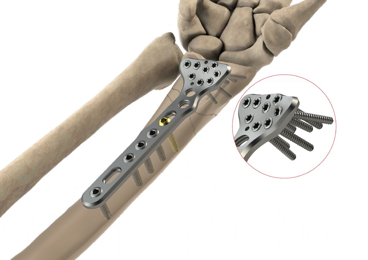 Upper Extremity Plates