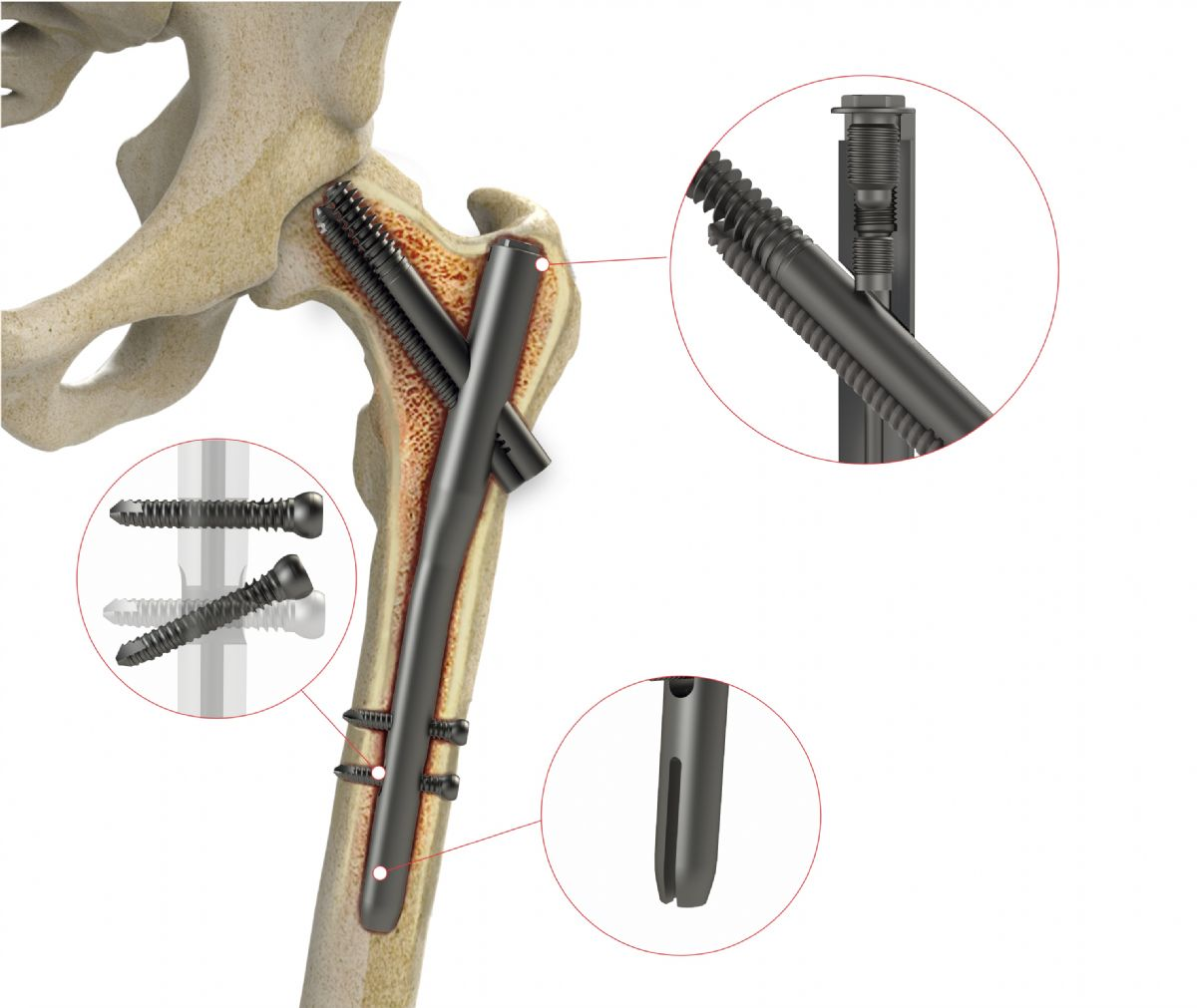 Intramedullary Nails