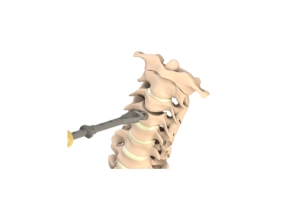 Spinal Fusion System
